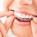 Invisalign Aligners