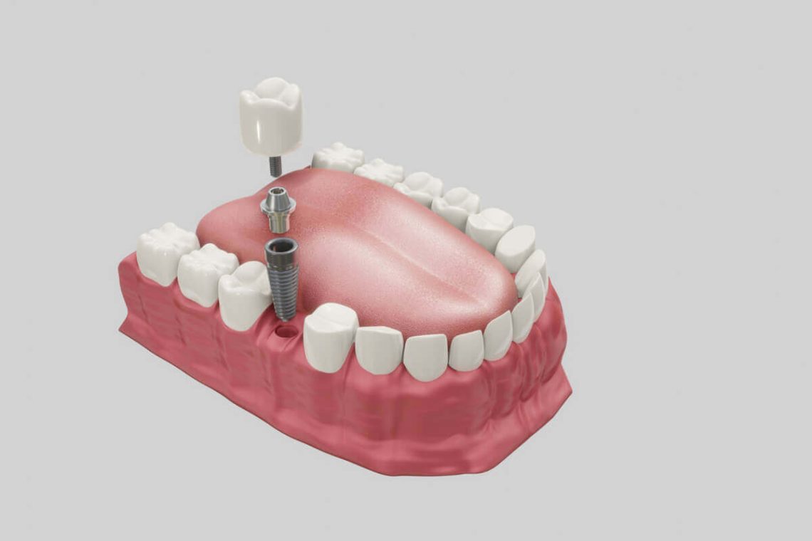 Embracing Confidence: The Revolution of Dental Implants in Sydney
