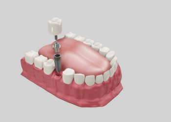 Embracing Confidence: The Revolution of Dental Implants in Sydney