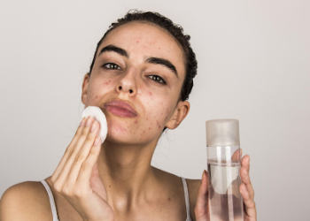 10 Essential Tips for Managing Acne-Prone Skin