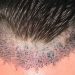 What Happens After a Hair Transplant