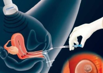 Embryo transfer explained: Getting to know one of the most important stages of IVF